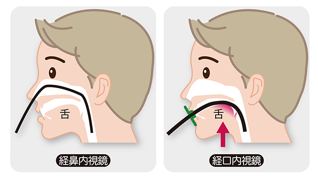 経鼻・経口選択可能